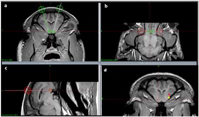 The Retrograde Connections and Anatomical Segregation of the Göttingen Minipig Nucleus Accumbens